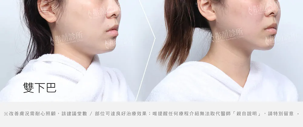 冷凍減脂瘦雙下巴輪廓線條更明顯前後效果比對