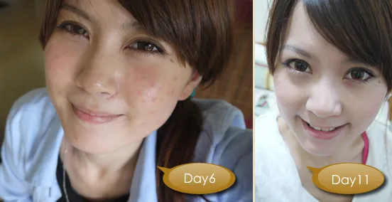 染料雷射治療效果