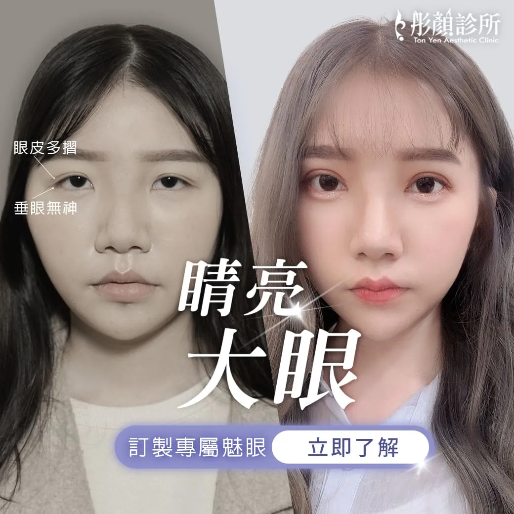 彤顏陳彥瑋醫師提眼瞼肌手術改善大小眼案例