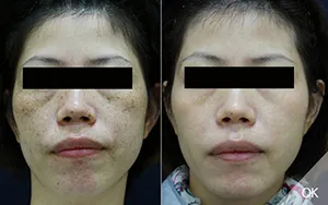 皮秒雷射顴骨母斑／混合班改善