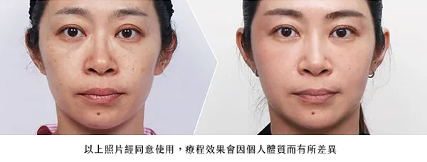 超級煥顏術-改善法令紋案例改善輪廓鬆弛