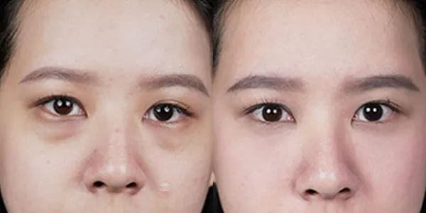 5D亮睛術消除眼袋淚溝術前術後效果對比案例