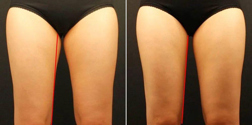冷凍減脂瘦大腿前後效果比對