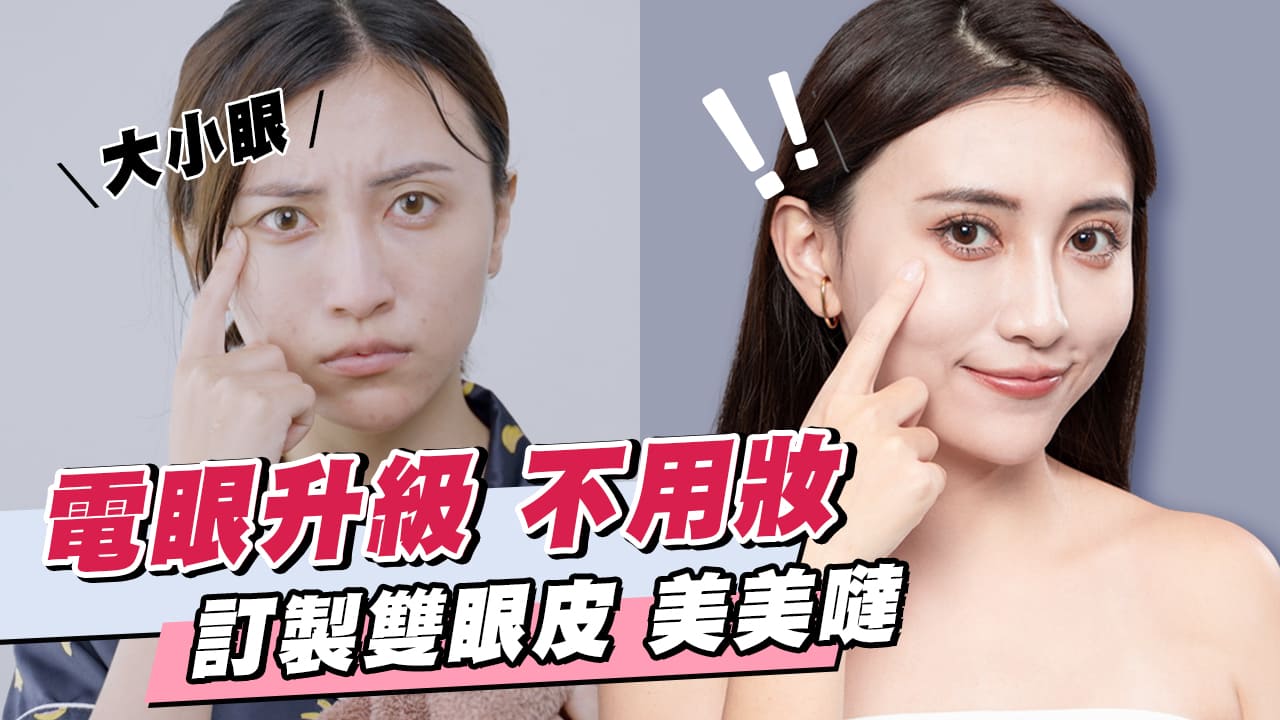 彤顏訂書針雙眼皮手術術前術後對比-桃園雙眼皮手術推薦