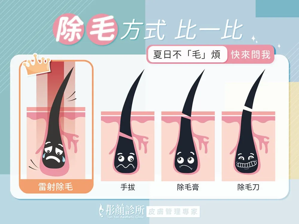 各式除毛方式比較:雷射除毛、除毛膏、除毛刀、拔毛