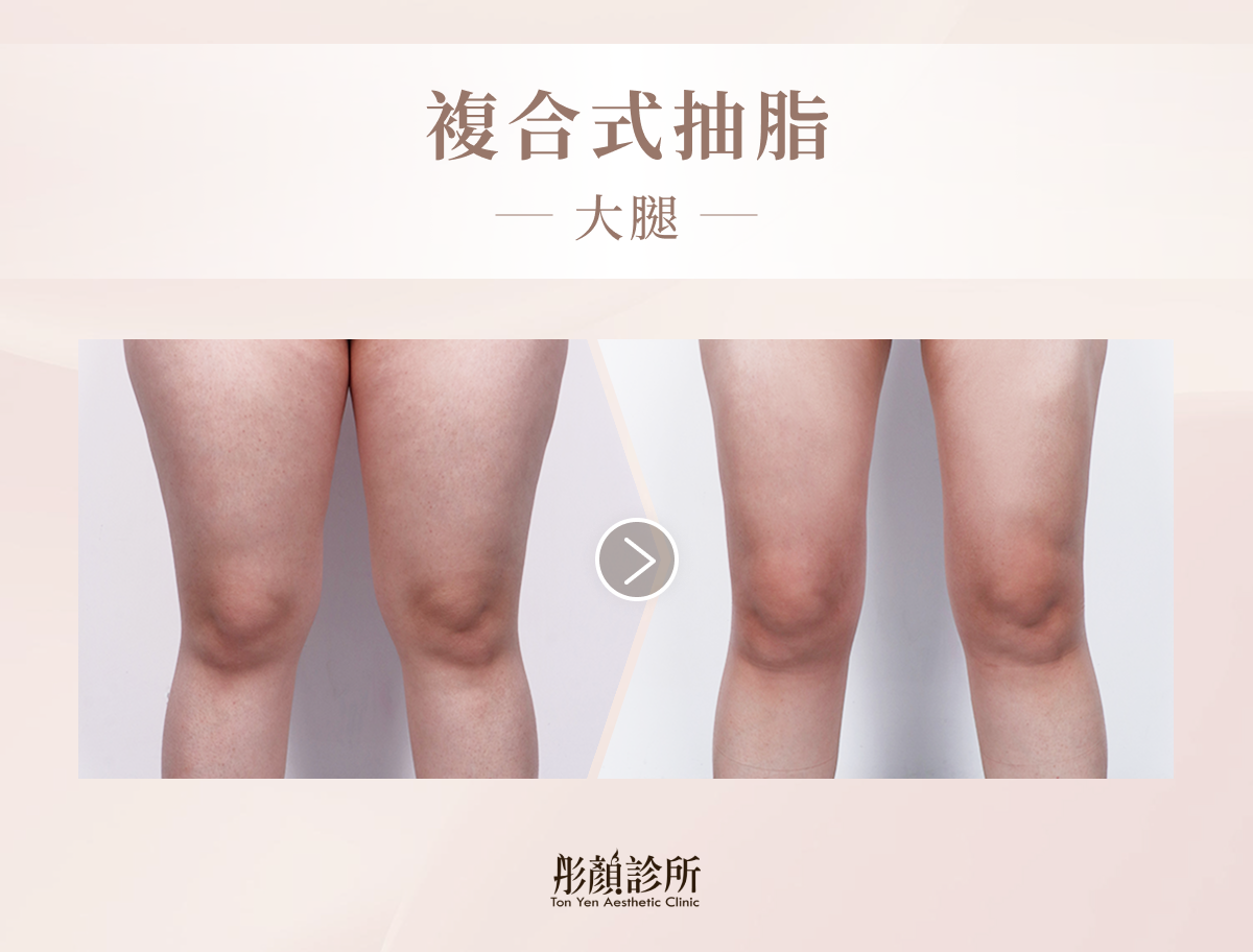 複合式抽脂（大腿）