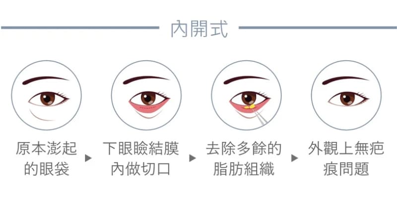 眼袋-眼袋手術-眼袋成因-眼袋費用-眼袋內開-眼袋外開-5D亮睛術-眼袋消除-眼袋原因-醫美