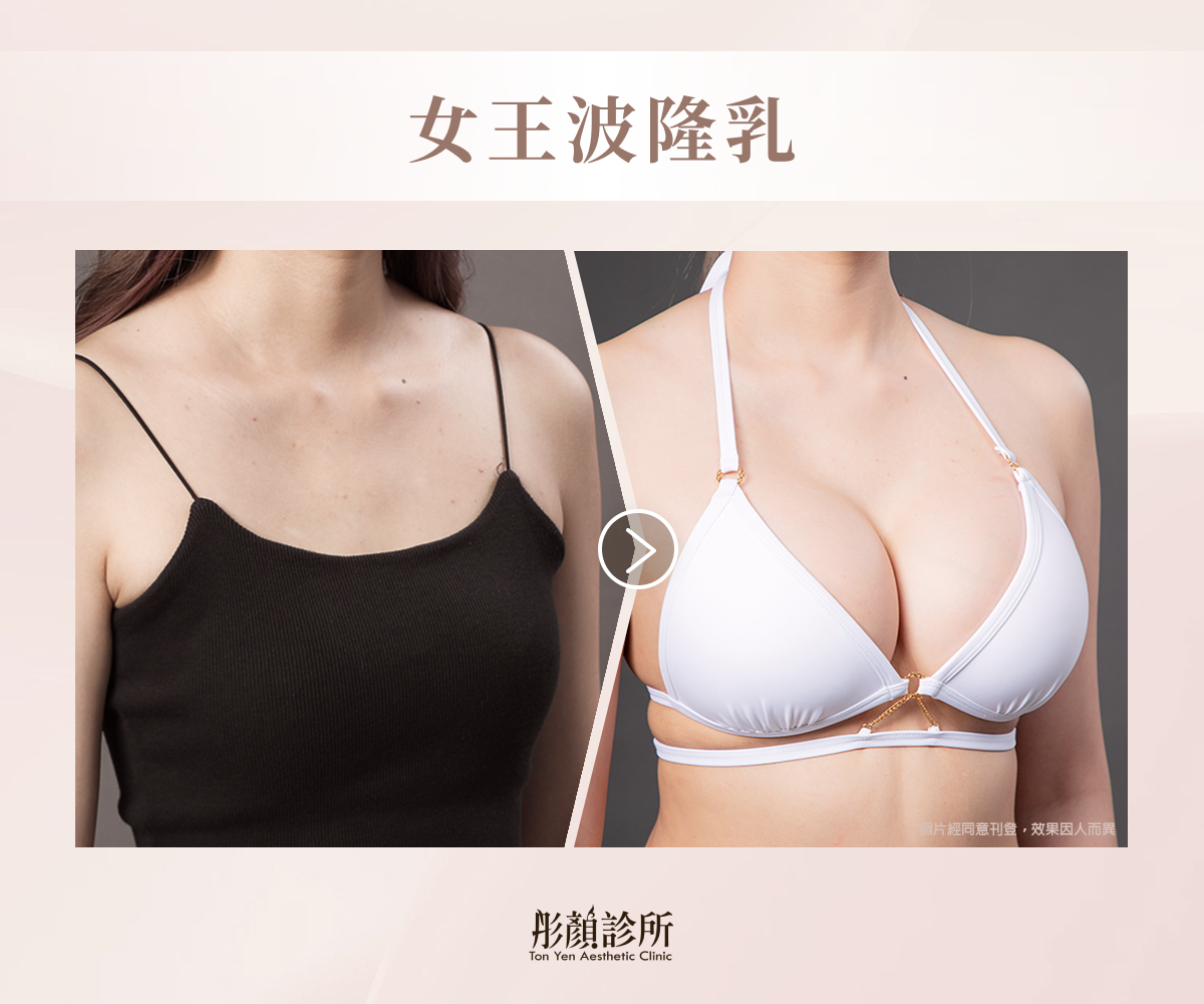 女王波隆乳案例