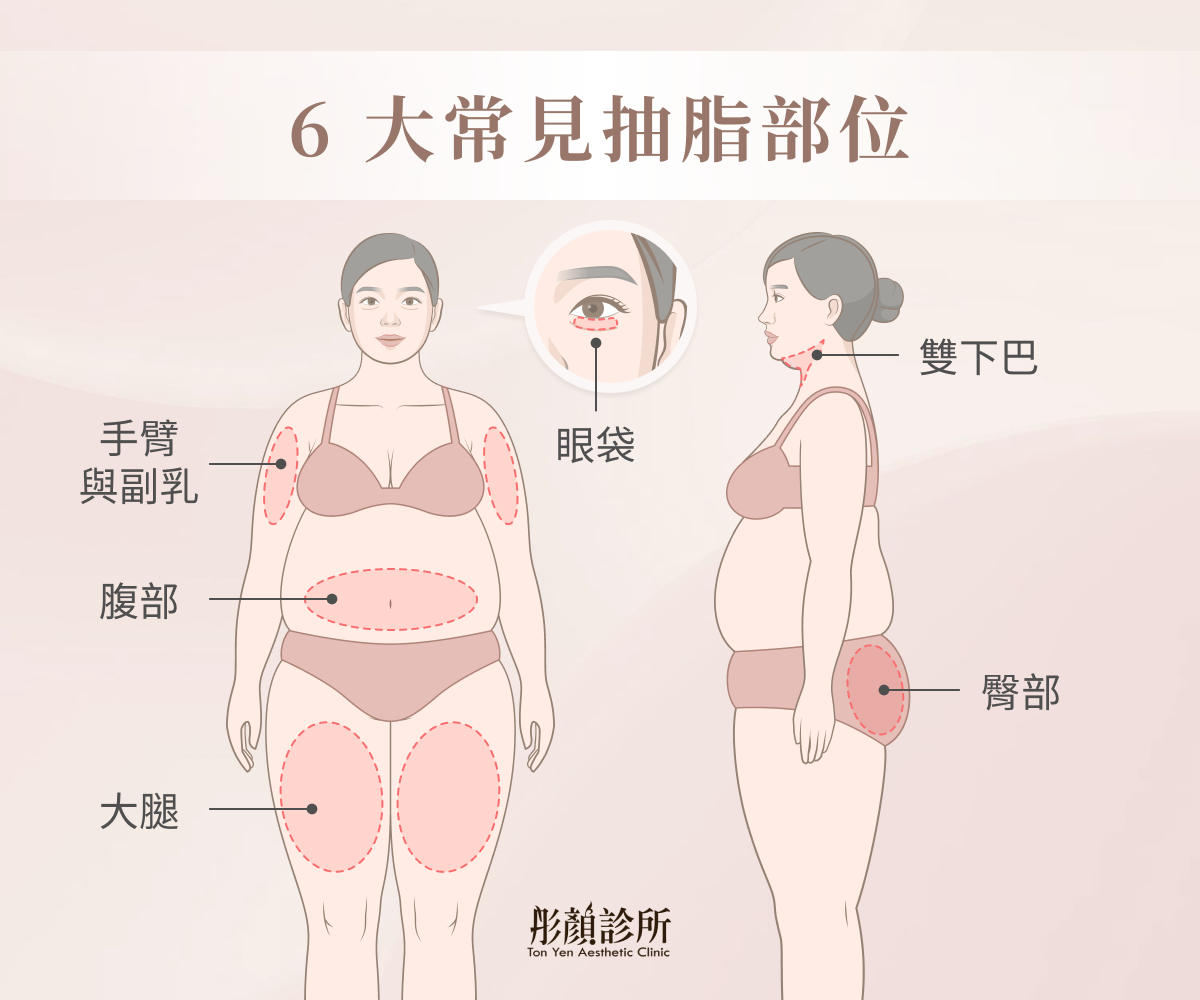 6 大常見抽脂部位