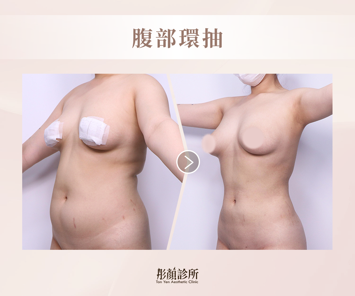 腹部環抽