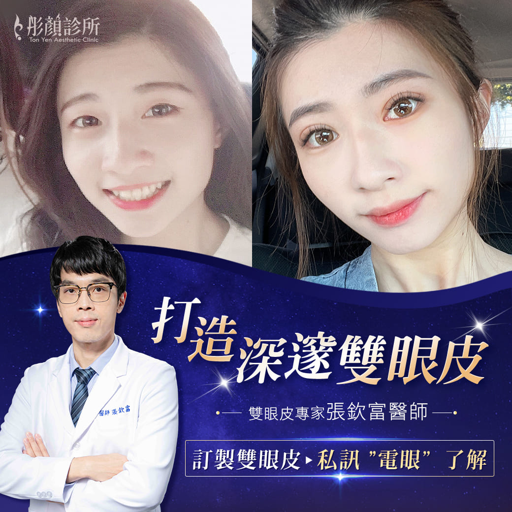 彤顏整形外科張欽富醫師-雙眼皮手術術前術後對比
