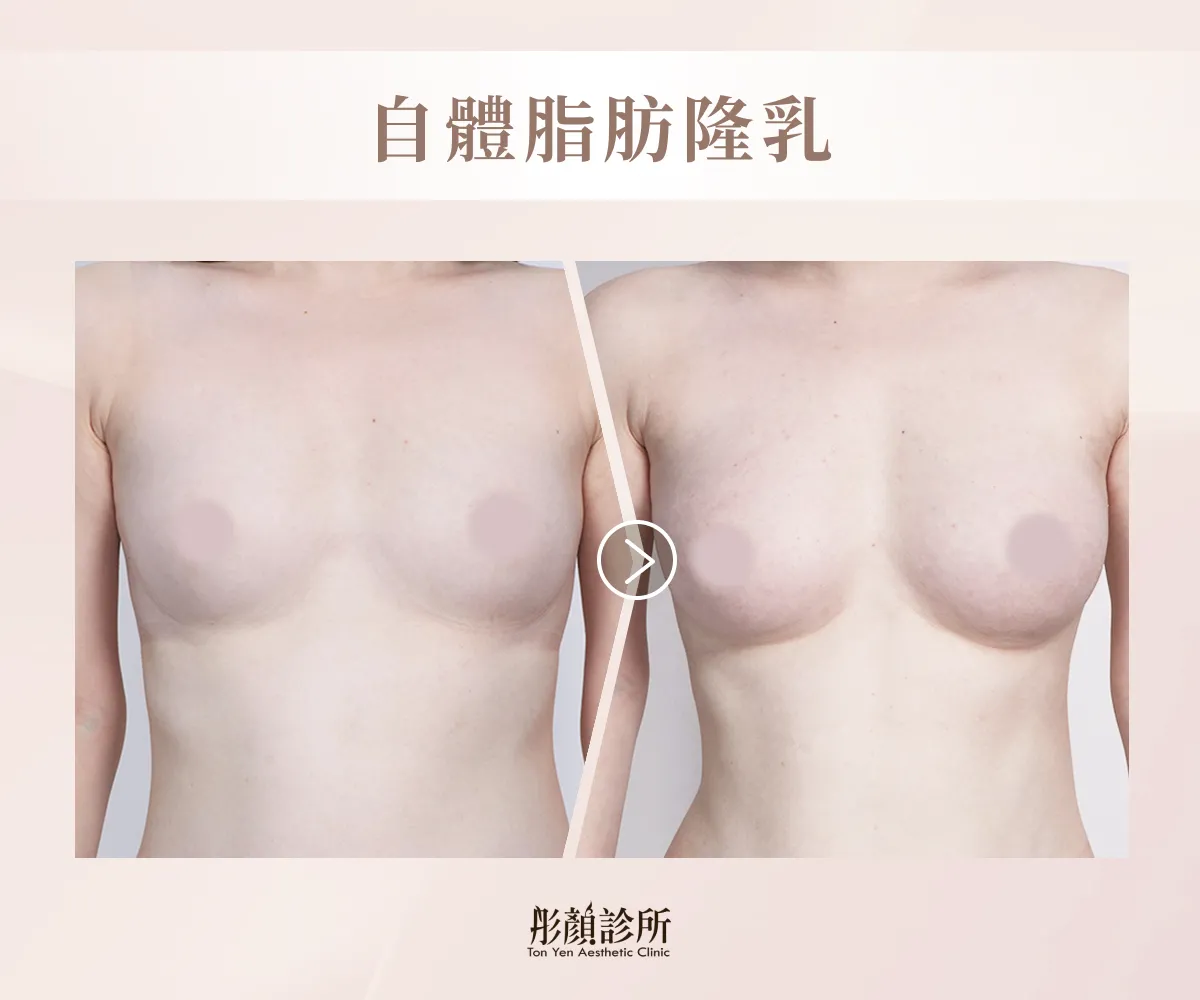 自體脂肪隆乳案例