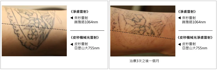 皮秒雷射除斑效果-皮秒雷射-皮秒雷射效果前後對比圖-蜂巢皮秒-皮秒雷射除斑-皮秒雷射痘疤-林口皮秒-桃園皮秒