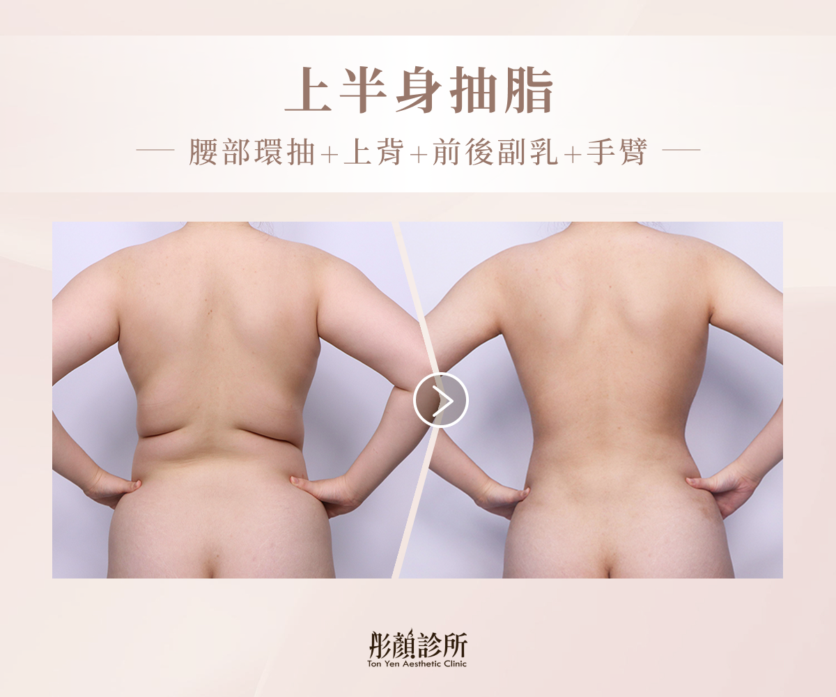 上半身抽脂