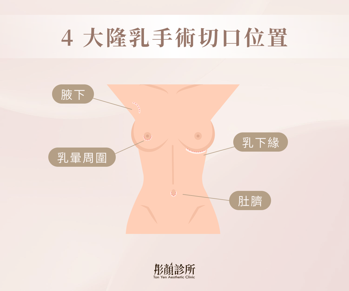 4 大隆乳手術切口位置