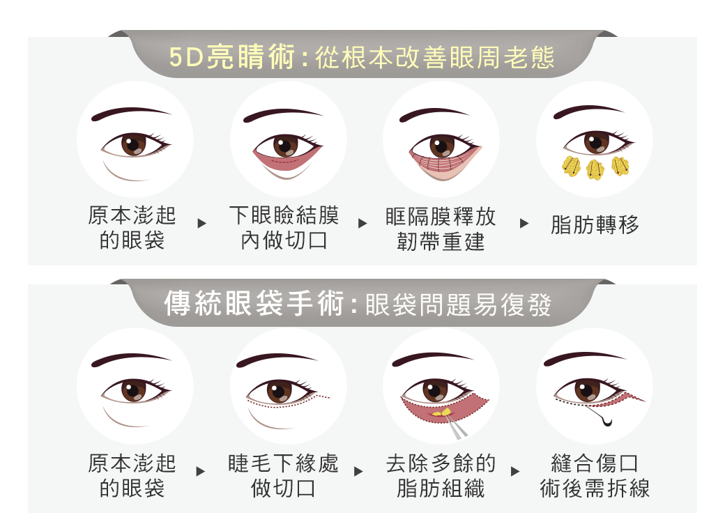 5D亮睛術-內開外開手術差異-眼袋手術推薦