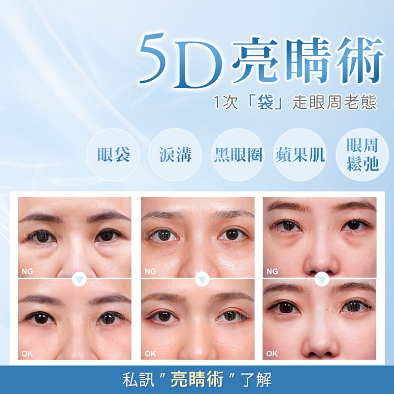 眼袋-眼袋手術-眼袋成因-眼袋費用-眼袋內開-眼袋外開-5D亮睛術眼袋消除效果-眼袋原因