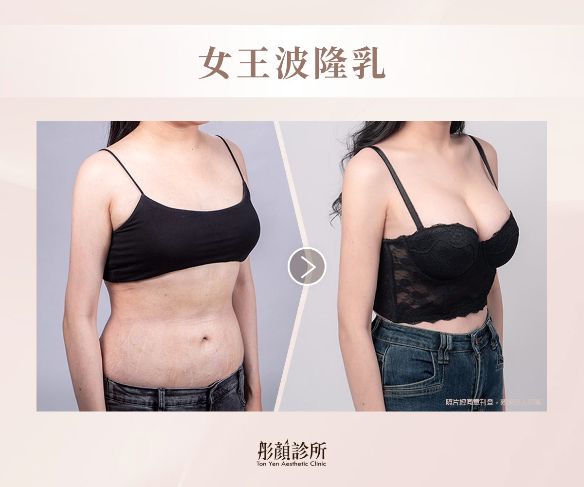 女王波隆乳案例