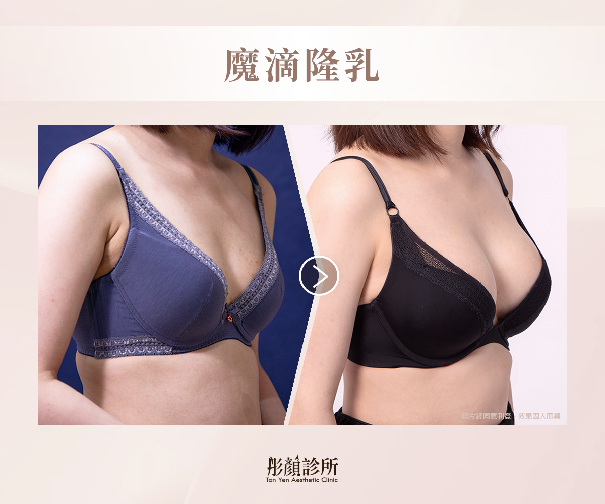 魔滴隆乳案例