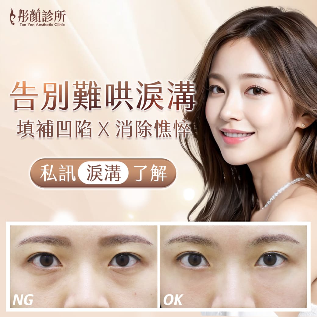 玻尿酸-玻尿酸注射-玻尿酸填充-玻尿酸效果-玻尿酸價格-玻尿酸醫美推薦