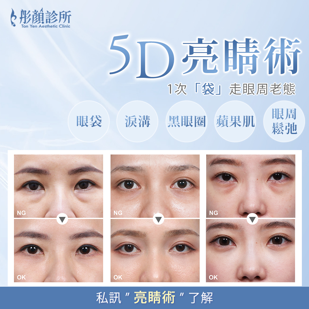 5d亮睛術效果-眼袋手術前後對比-眼袋淚溝改善案例