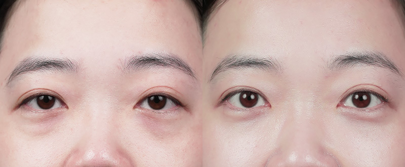 案例一：重度眼袋改善