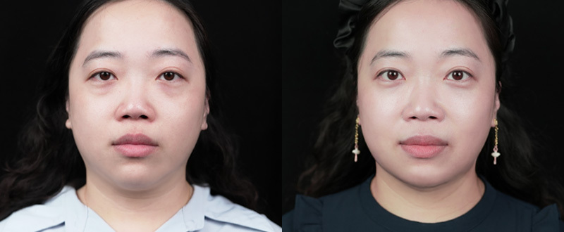 案例二：複合式眼周老化